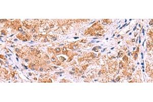 Immunohistochemistry of paraffin-embedded Human liver cancer tissue using UXS1 Polyclonal Antibody at dilution of 1:60(x200) (UXS1 抗体)
