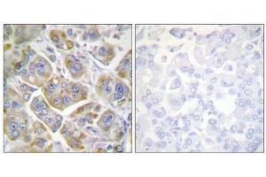 Immunohistochemistry analysis of paraffin-embedded human breast carcinoma tissue using ITGB4 (epitope around residue 1510) antibody. (Integrin beta 4 抗体  (Tyr1510))