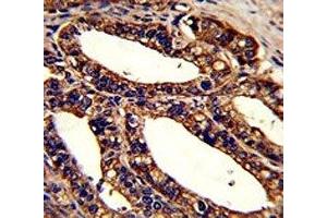 IHC analysis of FFPE human prostate carcinoma stained with ORAI1 antibody (ORAI1 抗体  (AA 145-173))