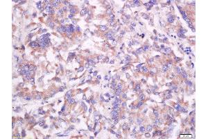 Formalin-fixed and paraffin embedded human lung carcinoma labeled with Anti-CD55/DAF Polyclonal Antibody, Unconjugated  at 1:200 followed by conjugation to the secondary antibody and DAB staining. (CD55 抗体  (AA 301-381))