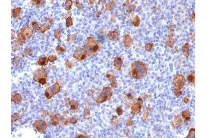 Formalin-fixed, paraffin-embedded human Hodgkin's Lymphoma stained with CD30 Rabbit Recombinant Monoclonal Antibody (Ki-1/1747R). (Recombinant TNFRSF8 抗体)