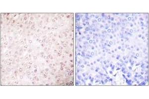 Immunohistochemistry analysis of paraffin-embedded human breast carcinoma tissue, using p300/CBP Antibody. (KAT2B 抗体  (AA 783-832))