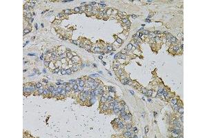 Immunohistochemistry of paraffin-embedded Human prostate using ALDH3A1 Polyclonal Antibody at dilution of 1:100 (40x lens). (ALDH3A1 抗体)