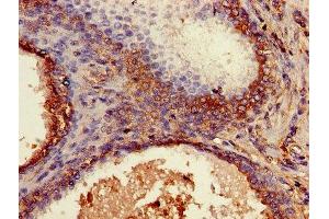 Immunohistochemistry of paraffin-embedded human prostate cancer using ABIN7145421 at dilution of 1:100 (beta-2 Microglobulin 抗体  (AA 21-119))