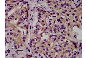 IHC image of ABIN7146788 diluted at 1:500 and staining in paraffin-embedded human liver cancer performed on a Leica BondTM system.