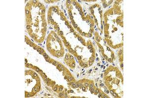 Immunohistochemistry of paraffin-embedded human kidney cancer using UGT1A4 antibody at dilution of 1:200 (400x lens). (UGT1A4 抗体)