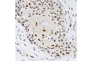Immunohistochemistry of paraffin-embedded human esophageal cancer using KPNA4 Antibody (ABIN5971058) at dilution of 1/200 (40x lens). (KPNA4 抗体)