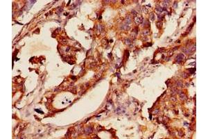 Immunohistochemistry of paraffin-embedded human gastric cancer using ABIN7154080 at dilution of 1:100 (Glutathione Reductase 抗体  (AA 47-219))