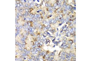 Immunohistochemistry of paraffin-embedded human prostate cancer using TFAM antibody (ABIN6290990) at dilution of 1:100 (40x lens). (TFAM 抗体)