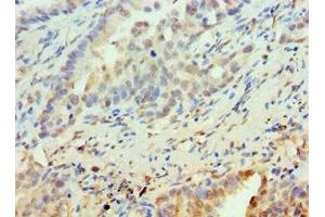 Immunohistochemistry of paraffin-embedded human lung cancer using ABIN7162505 at dilution of 1:100 (PAX6 抗体  (AA 1-300))