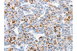 The image on the left is immunohistochemistry of paraffin-embedded Human liver cancer tissue using ABIN7128970(CLIP1 Antibody) at dilution 1/30, on the right is treated with fusion protein. (CLIP1 抗体)