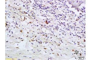 Formalin-fixed and paraffin embedded human breast carcinoma labeled with Anti- TLR5 Polyclonal Antibody, Unconjugated (ABIN673239) at 1:200 followed by conjugation to the secondary antibody and DAB staining (TLR5 抗体  (AA 701-810))