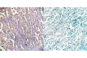 Immunohistochemical analysis of paraffin- embedded human lung carcinoma tissue using AMPKbeta1 (Ab-182) antibody (E022004). (PRKAB1 抗体)
