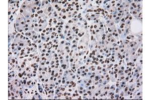 Immunohistochemical staining of paraffin-embedded Adenocarcinoma of breast tissue using anti-SCYL3 mouse monoclonal antibody. (SCYL3 抗体)