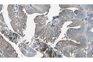 ABIN6277239 at 1/100 staining Human cervical cancer tissue by IHC-P. (SERPINH1 抗体  (Internal Region))