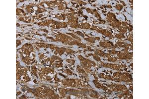 Immunohistochemistry of Human breast cancer using ARHGDIA Polyclonal Antibody at dilution of 1:30