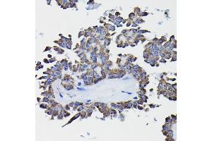 Immunohistochemistry of paraffin-embedded human thyroid cancer using GSTK1 Rabbit pAb (ABIN1680136, ABIN3019398, ABIN3019399 and ABIN6220875) at dilution of 1:25 (40x lens). (GSTK1 抗体  (AA 1-226))