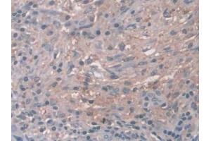 DAB staining on IHC-P; Samples: Human Breast cancer Tissue (Cathepsin Z 抗体  (AA 24-303))