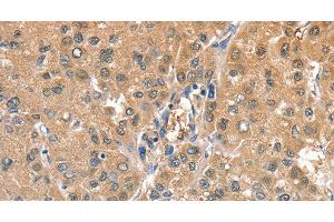Immunohistochemistry of paraffin-embedded Human liver cancer using CIAPIN1 Polyclonal Antibody at dilution of 1:60 (CIAPIN1 抗体)
