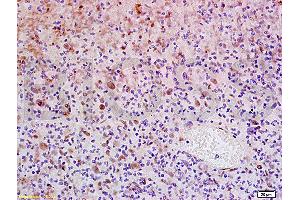 Formalin-fixed and paraffin embedded human glioma tissue labeled with Anti-WIG-1/PAG608 Polyclonal Antibody, Unconjugated (ABIN730108) at 1:200, followed by conjugation to the secondary antibody and DAB staining (ZMAT3 抗体  (AA 201-288))