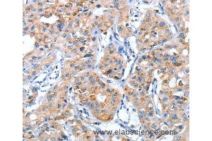 Immunohistochemistry of Human lung cancer using AUP1 Polyclonal Antibody at dilution of 1:50 (Ancient Ubiquitous Protein 1 抗体)