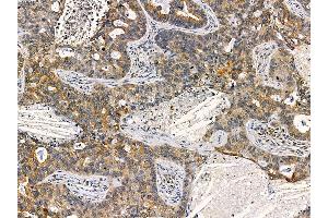 ABIN7095475 and ABIN7099532 at 1/100 staining human lung cancer by IHC-P. (TPD52 抗体)