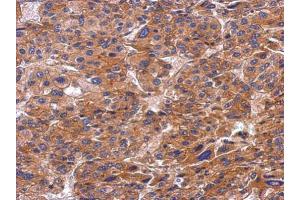 IHC-P Image Immunohistochemical analysis of paraffin-embedded human hepatoma, using SNX9, antibody at 1:500 dilution. (SNX9 抗体)
