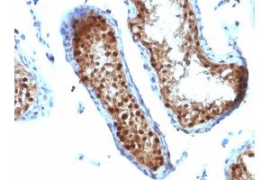 Formalin-fixed, paraffin-embedded human Testicular Carcinoma stained with SUMO-2 MAb (SUMO2/1199) (SUMO2 抗体)