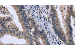 Immunohistochemistry of paraffin-embedded Human colon cancer tissue using KCNJ11 Polyclonal Antibody at dilution 1:40 (KCNJ11 抗体)