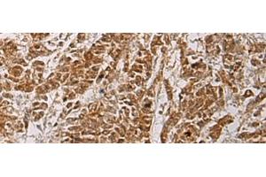 Immunohistochemistry of paraffin-embedded Human colorectal cancer tissue using HOXC5 Polyclonal Antibody at dilution of 1:55(x200) (Homeobox C5 抗体)