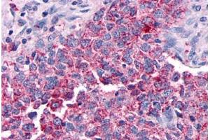 Anti-GPR30 antibody  ABIN1048792 IHC staining of human breast carcinoma.