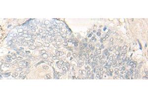 Immunohistochemistry of paraffin-embedded Human esophagus cancer tissue using DIMT1 Polyclonal Antibody at dilution of 1:30(x200) (DIMT1 抗体)