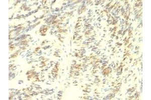 Formalin-fixed, paraffin-embedded human Leiomyosarcoma stained with Transglutaminase 2 antibody. (Transglutaminase 2 抗体)