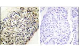 Immunohistochemistry analysis of paraffin-embedded human breast carcinoma tissue, using LATH Antibody. (LATH 抗体  (AA 71-120))