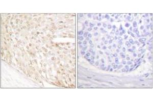 Immunohistochemistry analysis of paraffin-embedded human breast carcinoma tissue, using p18 INK Antibody. (P18 INK 抗体  (AA 111-160))