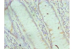 Immunohistochemistry of paraffin-embedded human colon cancer using ABIN7153695 at dilution of 1:100 (FABP6 抗体  (AA 1-128))