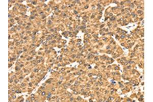 The image on the left is immunohistochemistry of paraffin-embedded Human liver cancer tissue using ABIN7130945(RRBP1 Antibody) at dilution 1/25, on the right is treated with fusion protein. (RRBP1 抗体)