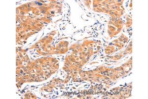Immunohistochemistry of Human lung cancer using AMPD1 Polyclonal Antibody at dilution of 1:80 (AMPD1 抗体)