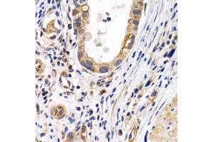 Immunohistochemistry of paraffin-embedded human gastric cancer using PTGIR antibody. (Prostacyclin Receptor 抗体)