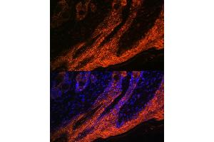 Immunofluorescence analysis of human skin cancer using IL1RA Rabbit mAb (ABIN7267971) at dilution of 1:100 (40x lens).