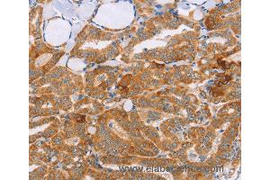 Immunohistochemistry of Human cervical cancer using CARD6 Polyclonal Antibody at dilution of 1:60 (CARD6 抗体)