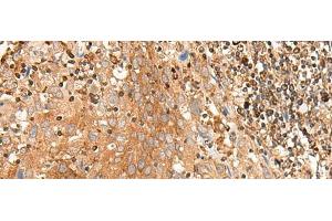 Immunohistochemistry of paraffin-embedded Human cervical cancer tissue using BAG3 Polyclonal Antibody at dilution of 1:35(x200) (BAG3 抗体)