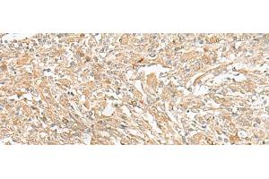 Immunohistochemistry of paraffin-embedded Human liver cancer tissue using GIPC1 Polyclonal Antibody at dilution of 1:50(x200) (GIPC1 抗体)