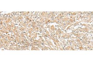 Immunohistochemistry of paraffin-embedded Human liver cancer tissue using GIPC1 Polyclonal Antibody at dilution of 1:50(x200) (GIPC1 抗体)