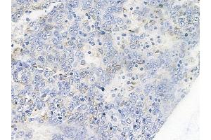 ABIN6255773 and ABIN6267263 at 1/100 staining human melanoma by IHC-P. (EGFR 抗体  (pTyr1086, pTyr1110))