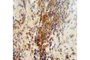 Immunohistochemistry analysis in human lung carcinoma (Formalin-fixed, Paraffin-embedded) using DNAJC11  Antibody (N-term), followed by peroxidase conjugated secondary antibody and DAB staining. (DNAJC11 抗体  (N-Term))
