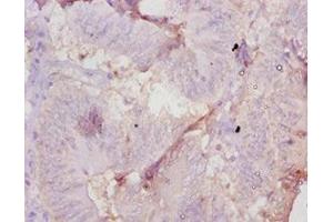 Immunohistochemistry of paraffin-embedded human colon cancer using ABIN7177698 at dilution of 1:10 (AMH 抗体  (AA 450-552))