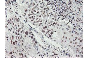 Immunohistochemical staining of paraffin-embedded Carcinoma of Human lung tissue using anti-MLF2 mouse monoclonal antibody. (MLF2 抗体)