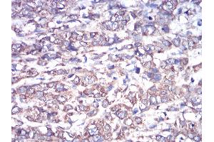 Immunohistochemical analysis of paraffin-embedded breast cancer tissues using GNAS mouse mAb with DAB staining.