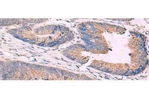 Immunohistochemistry of paraffin-embedded Human colorectal cancer tissue using KCNN3 Polyclonal Antibody at dilution of 1:40(x200) (KCNN3 抗体)